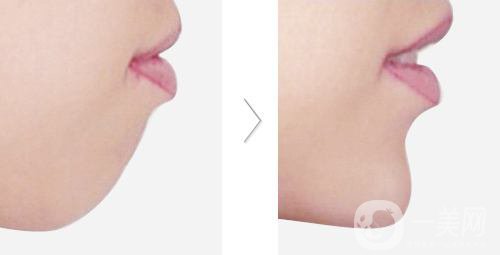 下頜骨后縮怎么矯正？矯正方法有哪些？