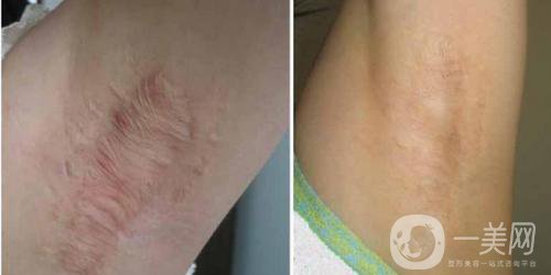 疤痕體質(zhì)怎么預(yù)防增生 疤痕體質(zhì)要注意什么