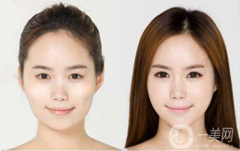 等離子激光溶脂價格 激光溶脂有副作用嗎