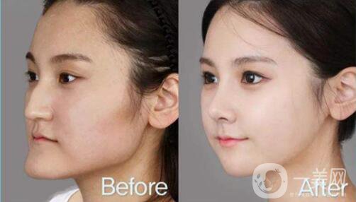 什么是面部不對稱手術(shù)