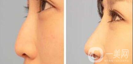 膨體隆鼻多久恢復,膨體隆鼻注意事項