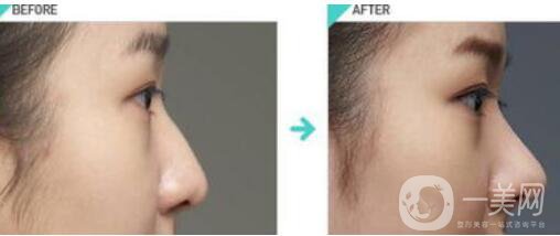 膨體肋骨隆鼻多久恢復(fù),膨體肋骨隆鼻術(shù)后護理