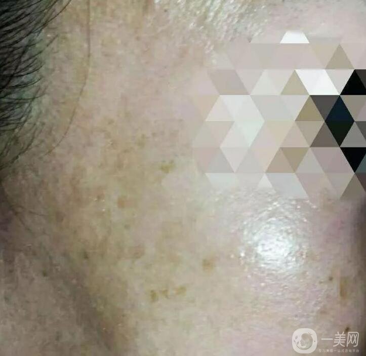 鐳射美白嫩膚*果