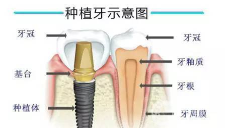 人工種植牙齒價(jià)格 手術(shù)費(fèi)用多少錢？