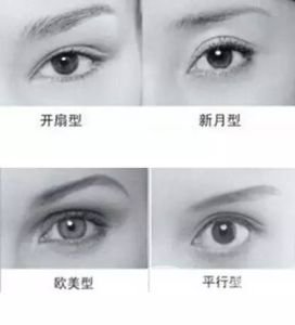 全切雙眼皮多久自然 手術有年齡限制嗎？