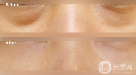 內(nèi)吸去眼袋多少錢 去眼袋方式有哪些？