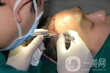 植發(fā)費用多少錢 價格高不高？