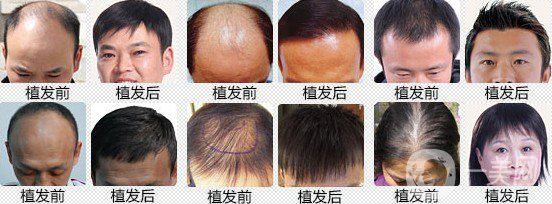 植發(fā)費用多少錢 價格高不高？