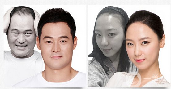 植發(fā)費(fèi)用一般是多少？植發(fā)前后