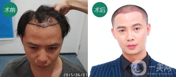 植發(fā)費(fèi)用一般是多少？植發(fā)前后