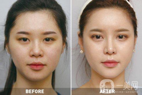 抽脂減肥有哪些副作用 抽脂減肥的價格