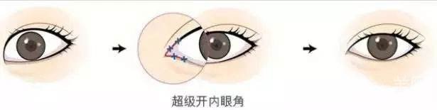 *開眼角怎么做的 *開眼角多久恢復