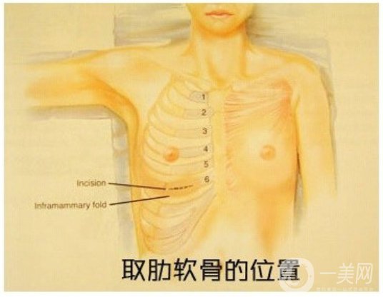 自體肋軟骨隆鼻危害有哪些？隆鼻價(jià)格