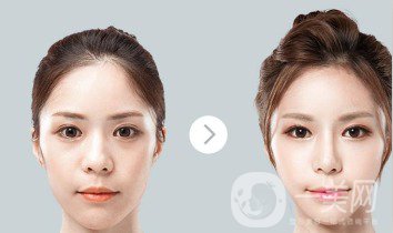 自體肋軟骨隆鼻危害有哪些？隆鼻價(jià)格