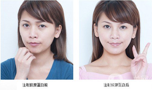 膠原蛋白針的副作用 危害有哪些？