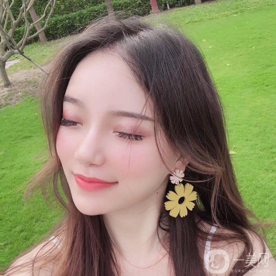 植發(fā)半年后案例 植發(fā)怎么樣？