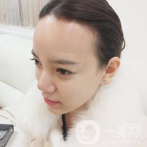 植發(fā)半年后案例 植發(fā)怎么樣？