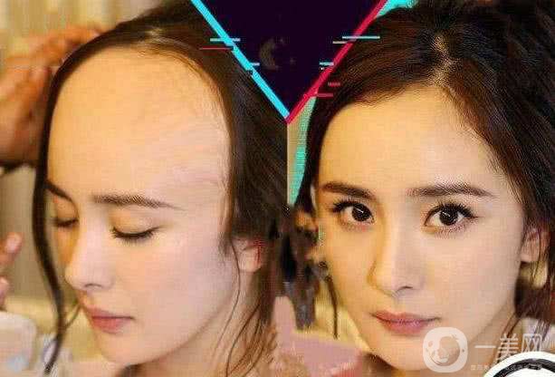 植發(fā)需要多少錢 植發(fā)多久恢復(fù)呢