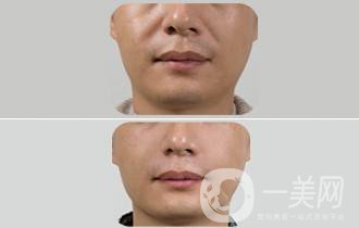 雙美膠原可以溶解嗎?雙美膠原蛋白有什么后遺癥?