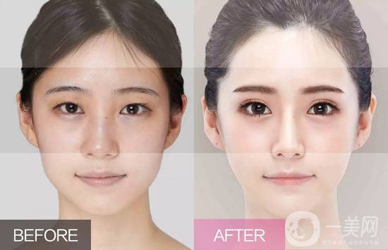 韓式隆鼻前后*果分享