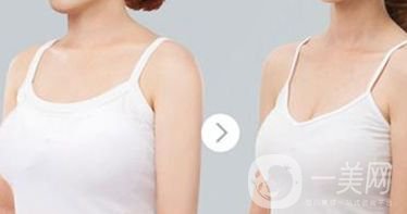 乳房下垂的診斷方法