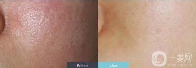 光子嫩膚能維持多久,光子嫩膚多少錢