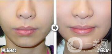 自體脂肪豐下巴費用,自體脂肪豐下巴*果