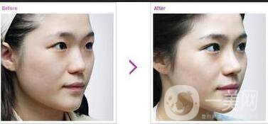 鼻尖整形費用,鼻尖整形注意事項