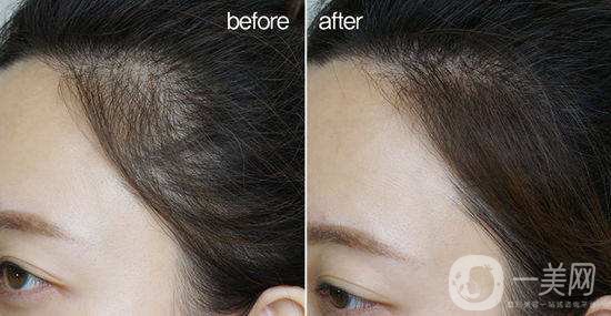 植發(fā)半年后*果是什么樣子的