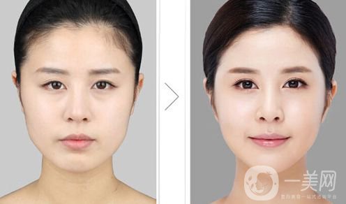 下頜角削骨多久恢復(fù) 下頜角削骨有危害嗎