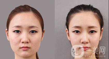 顴骨手術(shù)多久恢復(fù),顴骨手術(shù)注意事項