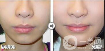 下巴打幾次能定型*,尿酸墊下巴多少錢