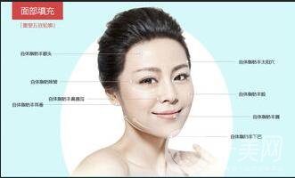 脂肪填充臉能維持幾年