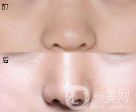 鼻翼縮小圖 鼻翼縮小有什么后遺癥嗎？