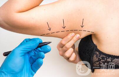 吸脂一般是怎樣收費(fèi)的呢?