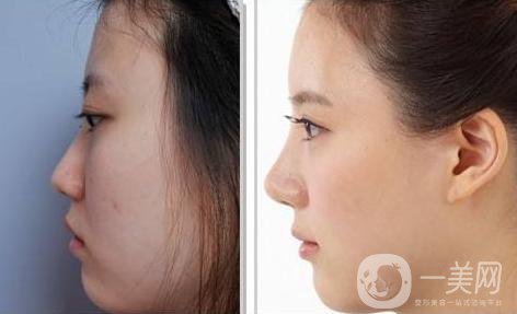 什么是短鼻手術(shù) 短鼻手術(shù)的作用