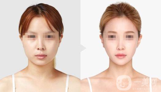 下頜角手術(shù)后多久*果才出來(lái) 多久消腫呢