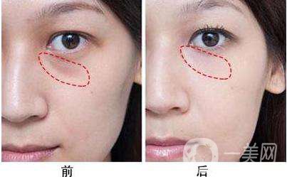 脂肪填充幾天開始吸收？