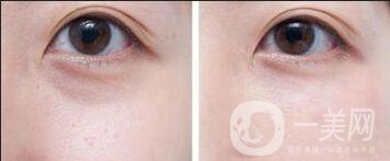 自體脂肪填充淚溝