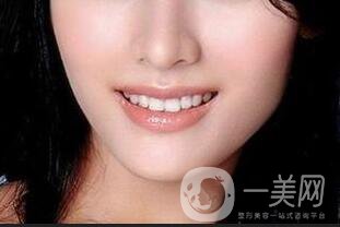 自體脂肪墊下巴多少錢(qián)