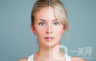 光子嫩膚多久做一次比較好？