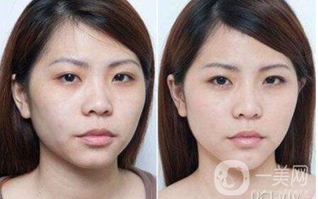 *多久見* 注射*的*果好不好