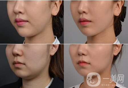 什么是自體脂肪墊下巴 自體脂肪填充的優(yōu)勢(shì)