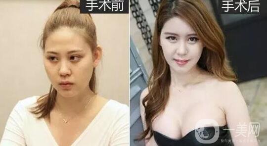 顴骨內(nèi)推術(shù)怎么做