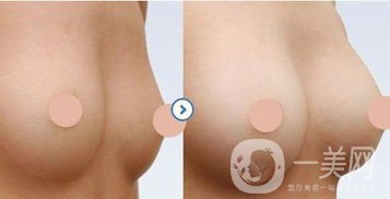 硅膠隆胸怎么樣？硅膠隆胸恢復(fù)期多久？