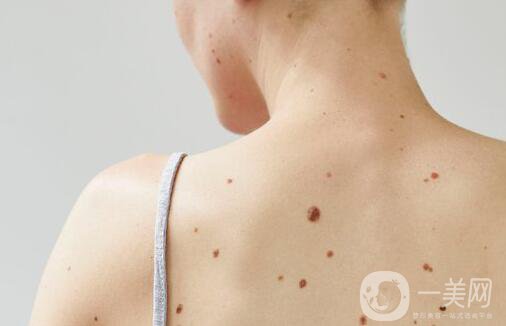 關(guān)于去痣你需要知道的
