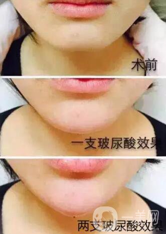 玻尿酸豐下巴需要幾針？兩針玻尿酸下巴*果圖