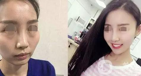 磨顴骨照片 磨顴骨*果怎么樣？