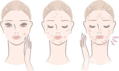 痤瘡調(diào)節(jié)方案 產(chǎn)生痤瘡的原因