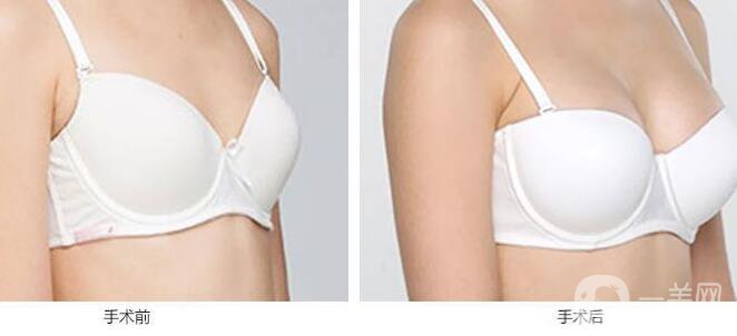 自體脂肪隆胸多久不疼?脂肪隆胸的害處?